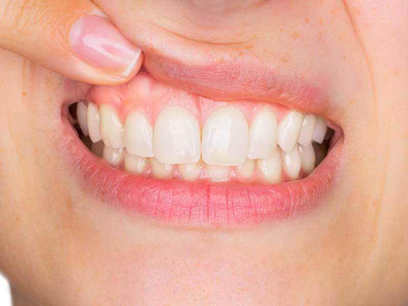 Periodontia Tratamento da Gengiva