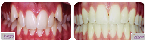 Caso de falta de espaço e sobremordida excessiva em dentição permanente.