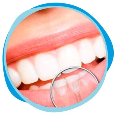Implante Dentário em Florianópolis Clínica Dentária Dentista